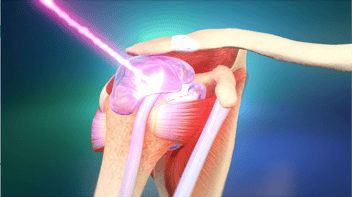 The Role of CureWave Lasers in Enhancing Primary Care Practices - Blog